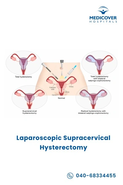 laparoscopic-supracervical-hysterectomy