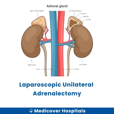 Laparoscopic Unilateral Adrenalectomy
