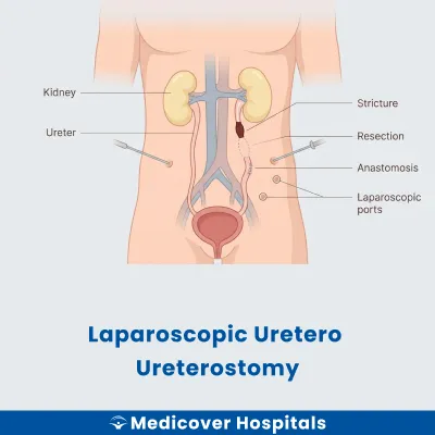Laparoscopic Uretero Ureterostomy
