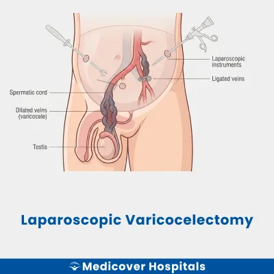 Laparoscopic Varicocelectomy