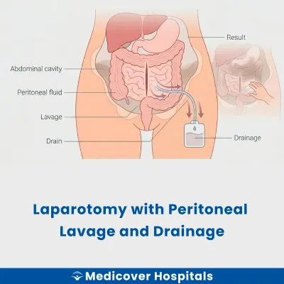 Laparotomy With Peritoneal Lavage and Drainage