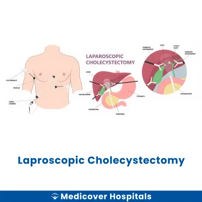 Laproscopic Cholecystectomy