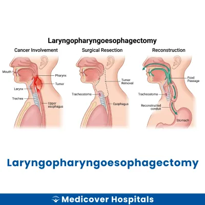 Laryngopharyngoesophagectomy
