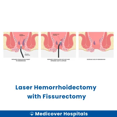 Laser Hemorrhoidectomy With Fissurectomy