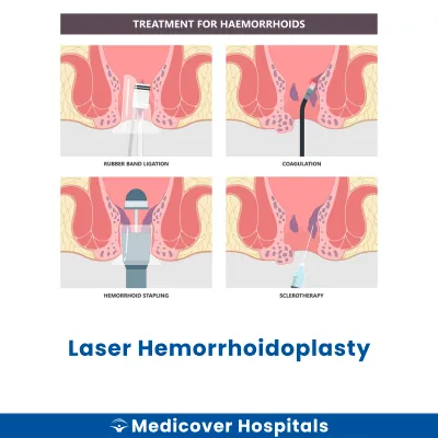 Laser Hemorrhoidoplasty