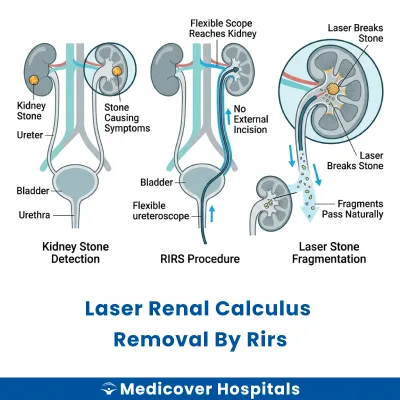 Laser Renal Calculus Removal By Rirs
