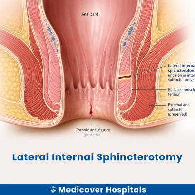 Lateral Internal Sphincterotomy