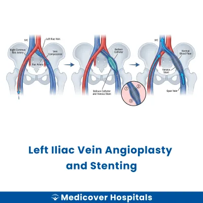 Left Iliac Vein Angioplasty and Stenting