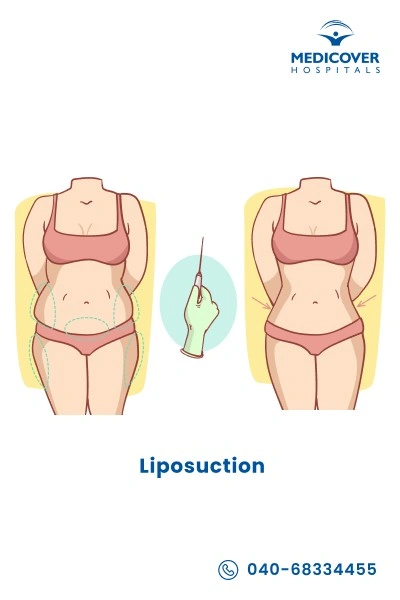 liposuction