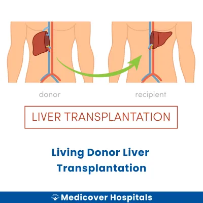 Living Donor Liver Transplantation