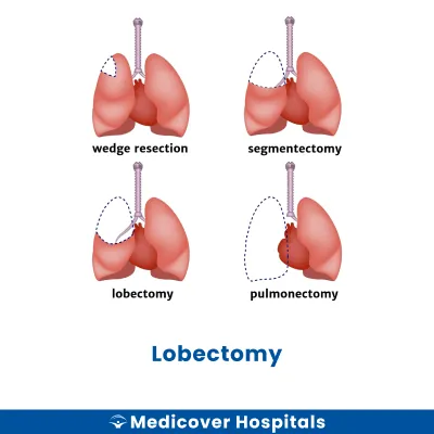 Lobectomy