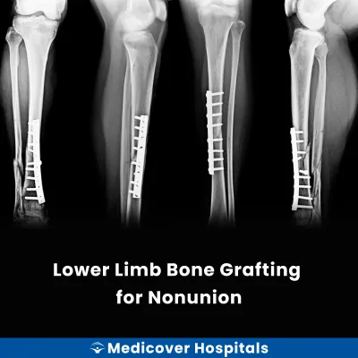 Lower Limb Bone Grafting for Nonunion