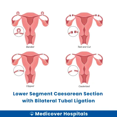 Lower Segment Caesarean Section With Bilateral Tubal Ligation