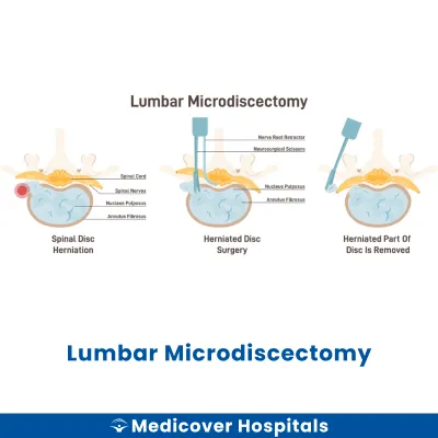 Lumbar Microdiscectomy