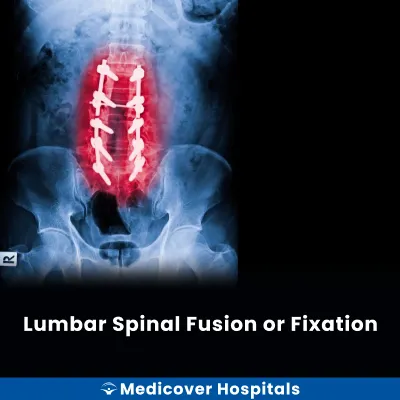Lumbar Spinal Fusion Or Fixation