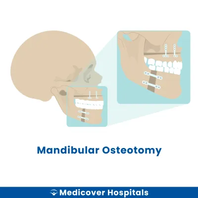 Mandibular Osteotomy