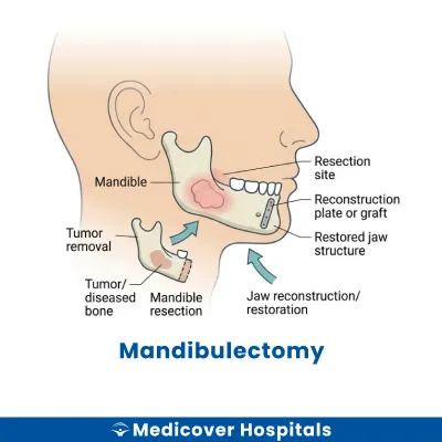 Mandibulectomy
