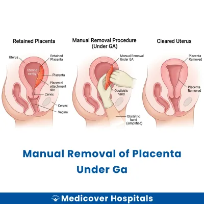 Manual Removal of Placenta Under Ga
