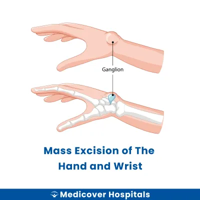 Mass Excision of The Hand and Wrist