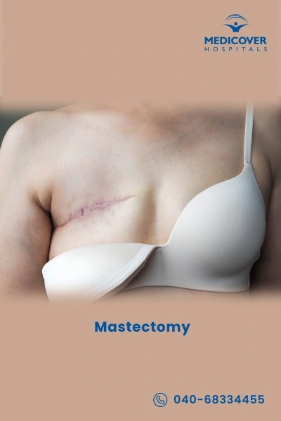 mastectomy