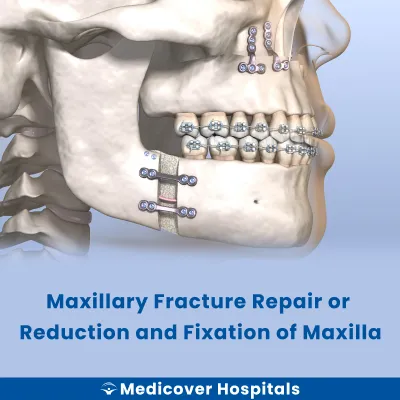 Maxillary Fracture Repair Or Reduction and Fixation of Maxilla