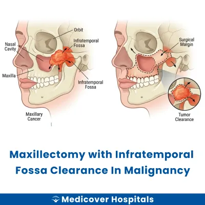Maxillectomy With Infratemporal Fossa Clearance In Malignancy