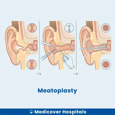 Meatoplasty
