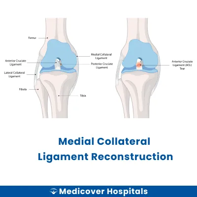 Medial Collateral Ligament Reconstruction