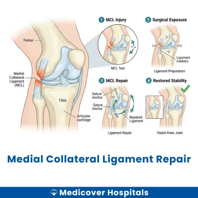 Medial Collateral Ligament Repair