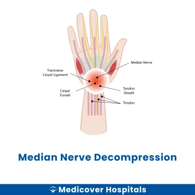 Median Nerve Decompression