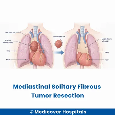 Mediastinal Solitary Fibrous Tumor Resection