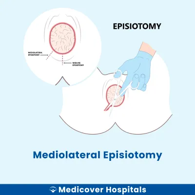Mediolateral Episiotomy