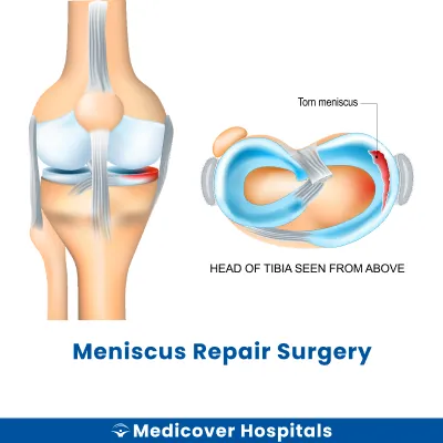Meniscus Repair Surgery