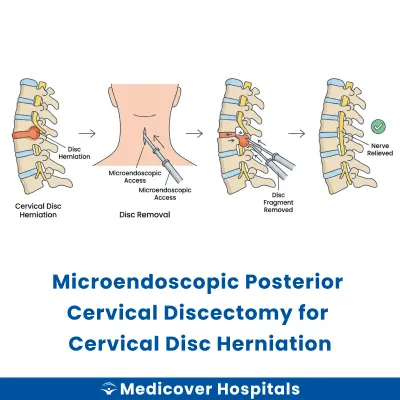 Microendoscopic Posterior Cervical Discectomy for Cervical Disc Herniation