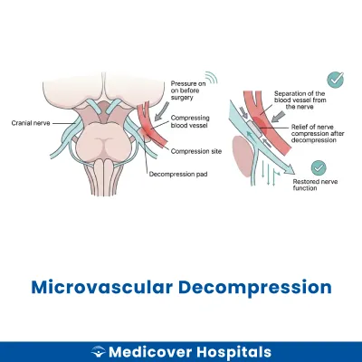 Microvascular Decompression