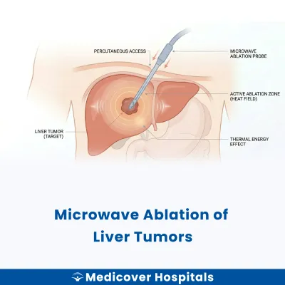 Microwave Ablation of Liver Tumors