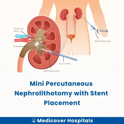 Mini Percutaneous Nephrolithotomy With Stent Placement