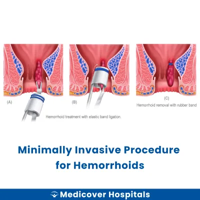 Minimally Invasive Procedure for Hemorrhoids
