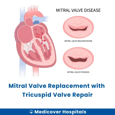 Mitral Valve Replacement With Tricuspid Valve Repair
