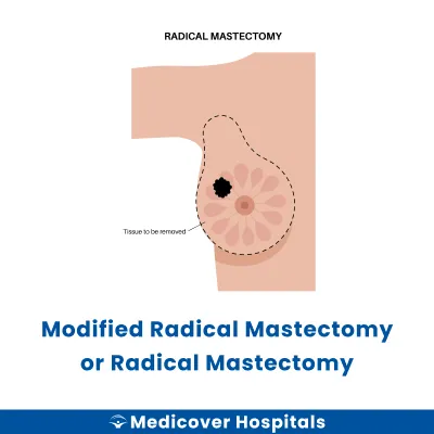 Modified Radical Mastectomy Or Radical Mastectomy