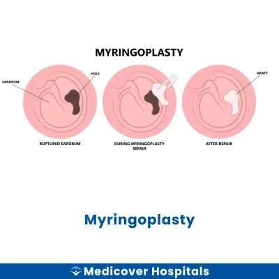 Myringoplasty