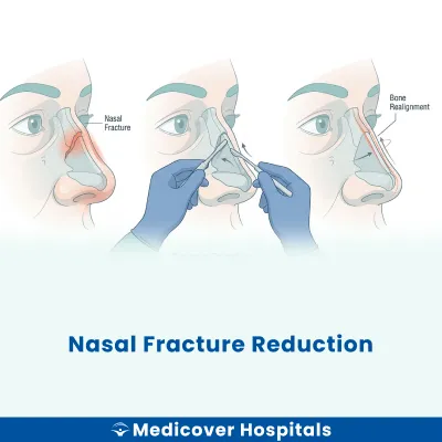 Nasal Fracture Reduction