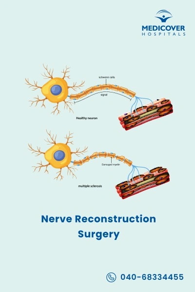 nerve-reconstruction