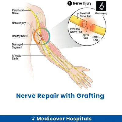 Nerve Repair With Grafting