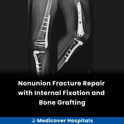 Nonunion Fracture Repair With Internal Fixation and Bone Grafting