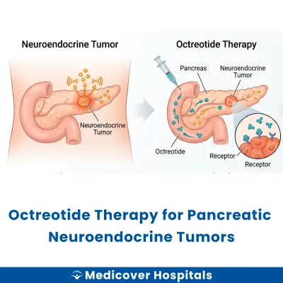 Octreotide Therapy for Pancreatic Neuroendocrine Tumors