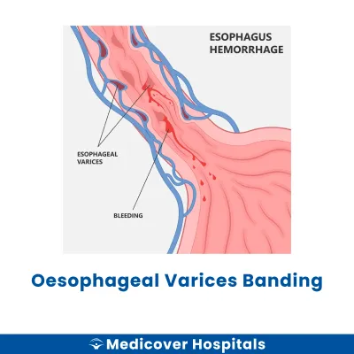 Oesophageal Varices Banding