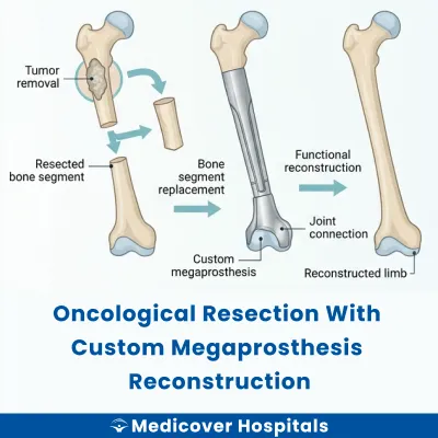Oncological Resection With Custom Megaprosthesis Reconstruction