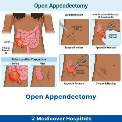 Open Appendectomy