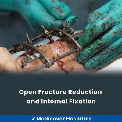 Open Fracture Reduction and Internal Fixation